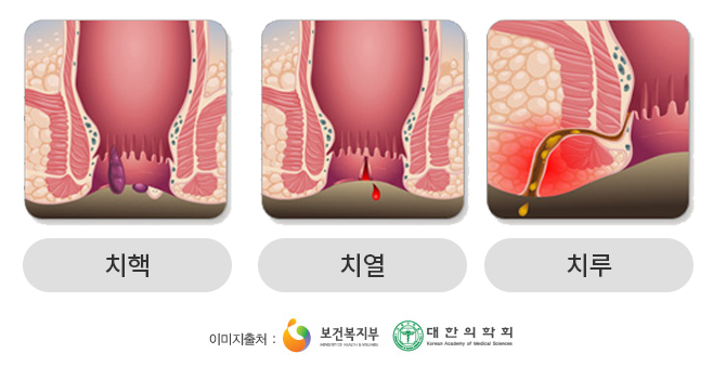 치핵, 치열, 치루 이미지