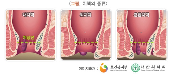 치핵의 종류
