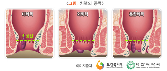 치핵의 종류