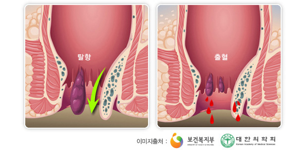 내치핵의 증상 :탈항과 출혈