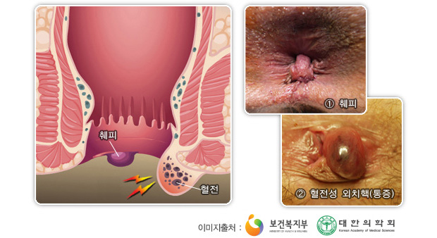 외치핵의 증상 : 통증과 피부주름(늘어진 살)