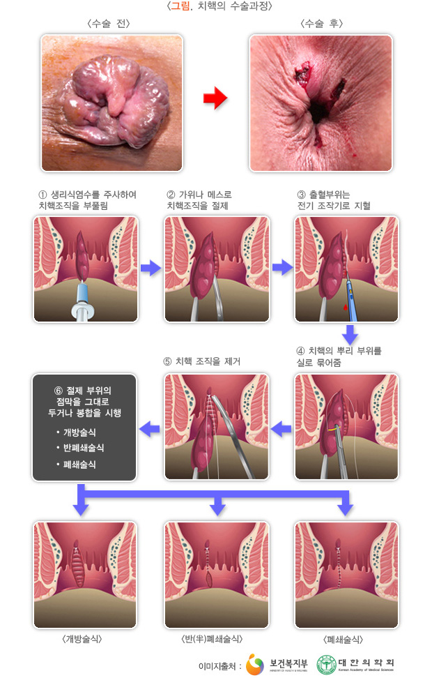치핵의 수술과정