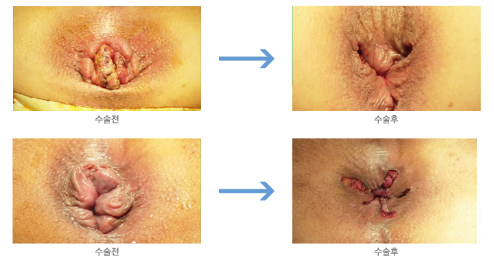 수술전후이미지