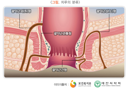 치루의 분류