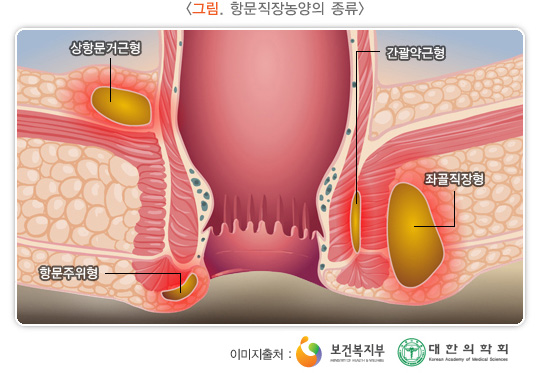 항문직장농양의 종류