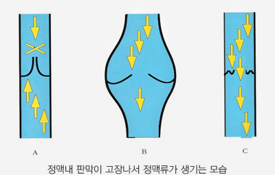 정맥내 판막이 고장나서 정맥류가 생기는 모습