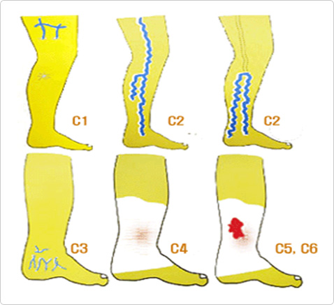 하지정맥류의 진행에 따른 임상양상의 변화 안내 이미지