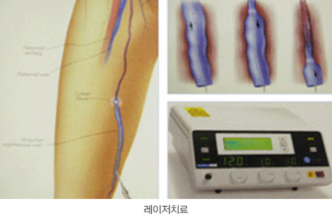 레이저치료 이미지