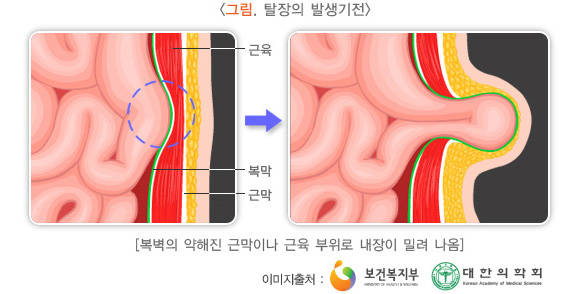 탈장의 발생기전