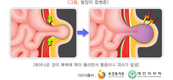 탈장의 합병증